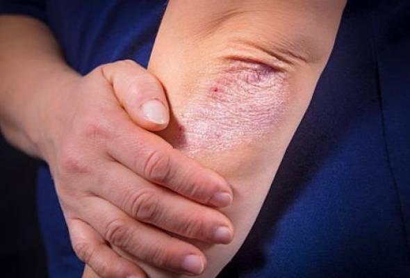 Svjetski dan psorijaze - Vijesti - Elatus
